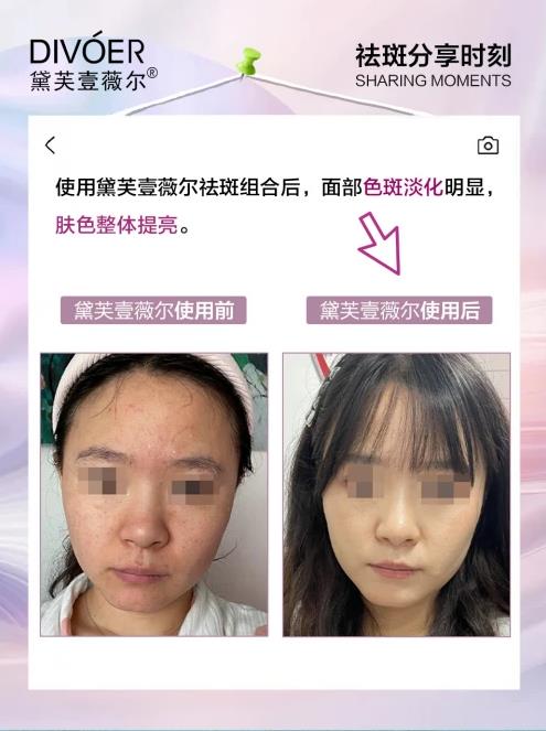 黛芙壹薇爾(divoer)祛斑效果怎么樣?不愧是國(guó)家認(rèn)證的祛斑組合