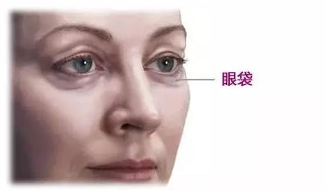 日常該怎么預(yù)防眼袋的形成 有眼袋該怎么去眼袋