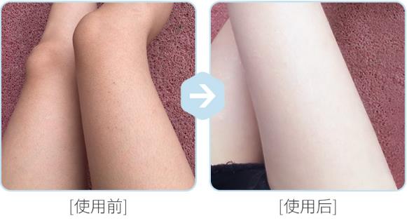 腿上雞皮膚嚴重怎么弄,最有效方法解您雞皮膚困擾