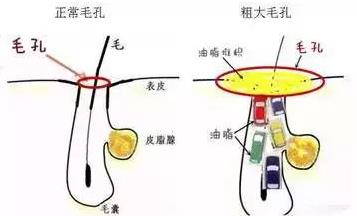 北京伊美爾愛康醫(yī)院:超微小氣泡是什么