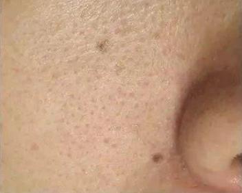 北京伊美爾愛康醫(yī)院:超微小氣泡是什么