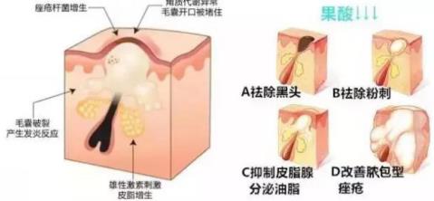 北京伊美爾健翔醫(yī)院:果酸煥膚有危險嗎