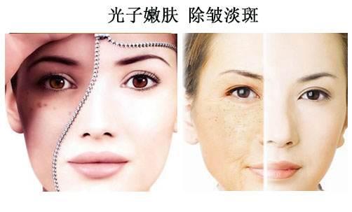 光子去魚(yú)尾紋要注意什么?光子嫩膚法祛痘印效果好嗎