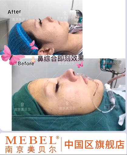 黃名斗隆鼻怎么樣?還您后天“自然”美俏鼻