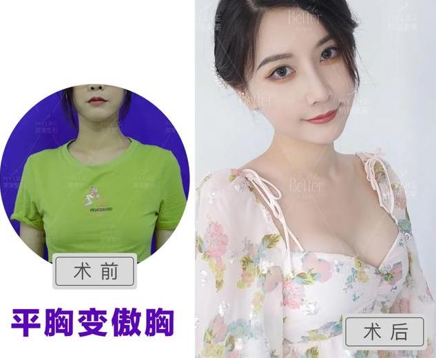 杭州美萊栗勇教授科普假體隆胸假體,究竟要怎么選擇合適自己的呢?