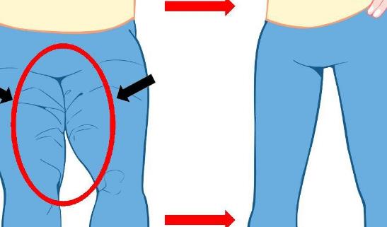 大腿抽脂多久恢復(fù)?大腿抽脂的后遺癥有哪些?