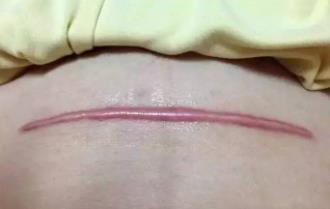 剖腹產(chǎn)疤痕為什么會發(fā)癢 重慶瑪恩皮膚祛疤分型治療