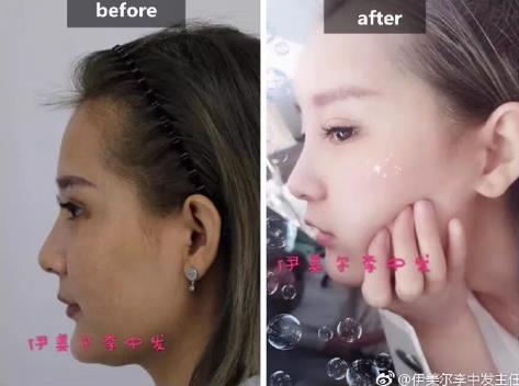伊美爾愛(ài)康醫(yī)院自體脂肪填充效果好不好?