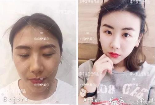 伊美爾愛(ài)康醫(yī)院自體脂肪填充效果好不好?