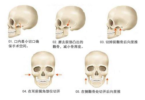 顴骨增高手術(shù)適合哪些人做?顴骨增高手術(shù)的注意事項