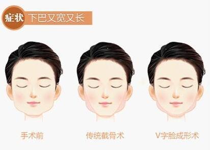 下頜骨整形術(shù)后的護(hù)理方法-下頜骨整形術(shù)的適應(yīng)癥