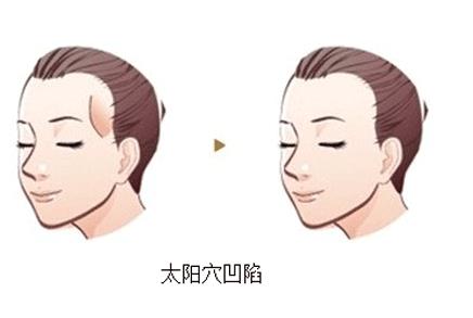 如何提高豐顳術(shù)的自體脂肪成活率
