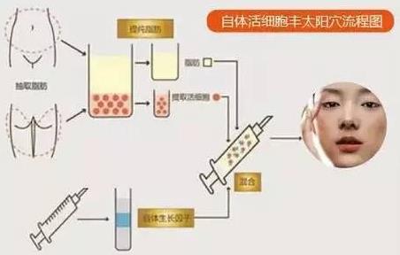 如何提高豐顳術(shù)的自體脂肪成活率