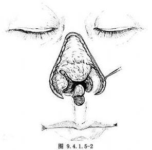 廈門臉博士整形醫(yī)院可信嗎 拉斯鼻整形修復(fù)技術(shù)免費拯救了這個無鼻小孩