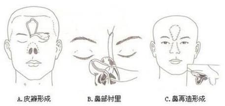 廈門臉博士整形醫(yī)院可信嗎 拉斯鼻整形修復(fù)技術(shù)免費拯救了這個無鼻小孩