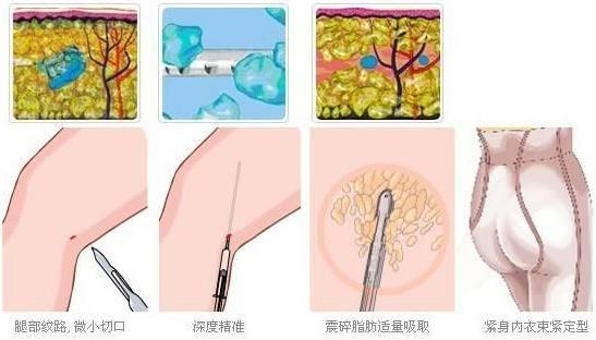 南京韓辰吸脂術(shù) 力求整形美無痕