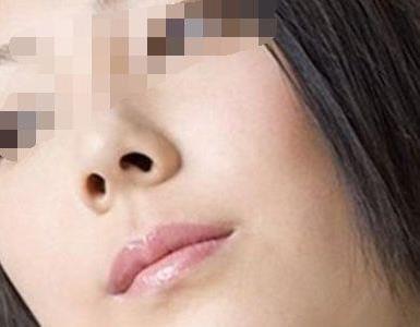 昆明韓辰鼻孔縮小手術(shù) 你蒜頭鼻子的煩惱 我們幫你清除