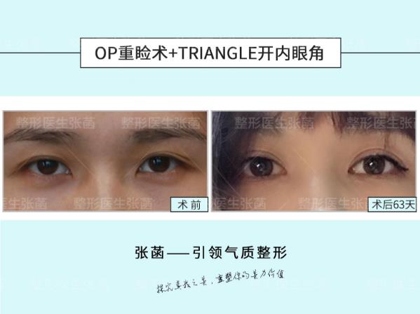 埋線(xiàn)雙眼皮、韓式三點(diǎn)及菡式OP重瞼術(shù)哪種方式更適合你吶?