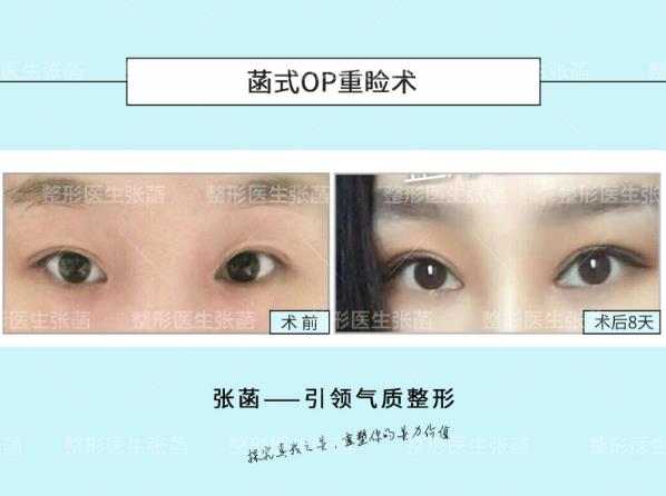 埋線(xiàn)雙眼皮、韓式三點(diǎn)及菡式OP重瞼術(shù)哪種方式更適合你吶?