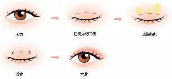埋線(xiàn)雙眼皮、韓式三點(diǎn)及菡式OP重瞼術(shù)哪種方式更適合你吶?