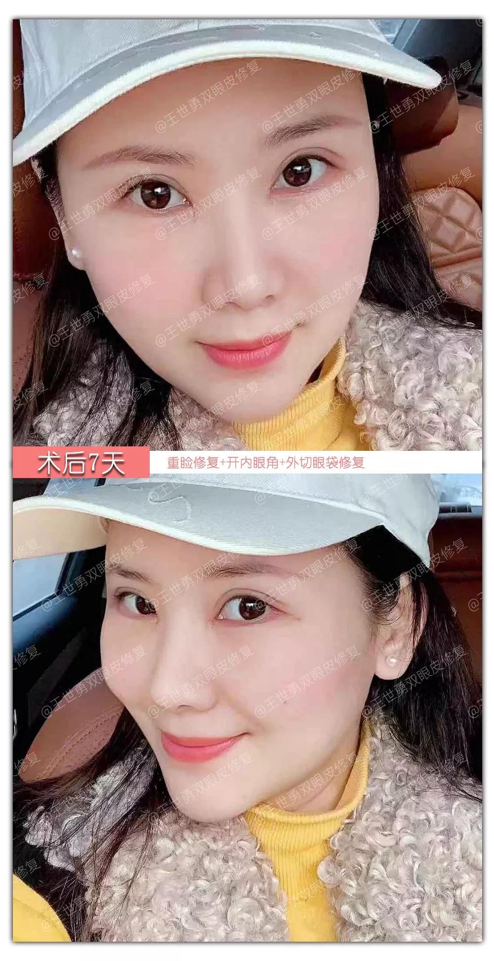 【王世勇】雙眼皮(初眼)案例分享讓自己看到更美的自己