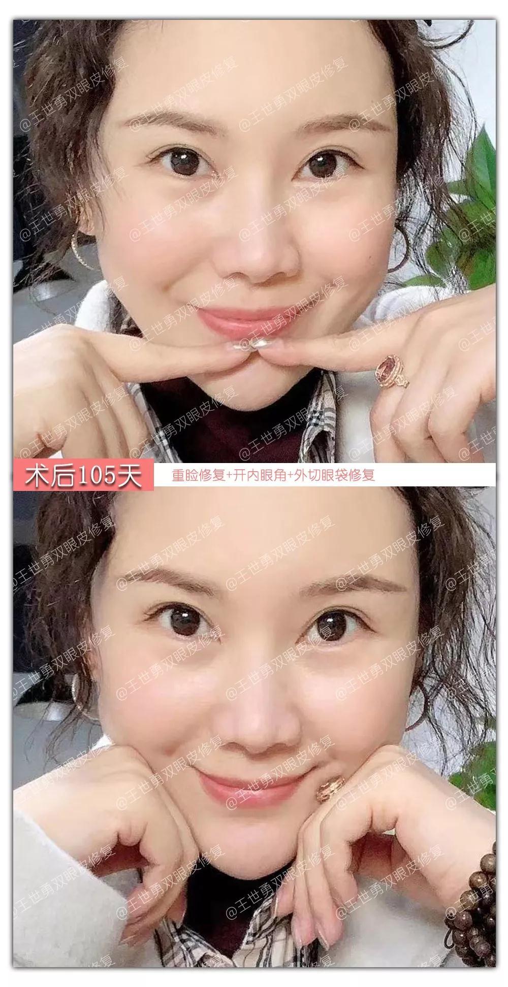 【王世勇】雙眼皮(初眼)案例分享讓自己看到更美的自己