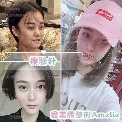 鄭州愛(ài)美麗醫(yī)院,有一種肉毒素,打了“它”,男友比原來(lái)更加愛(ài)你了!