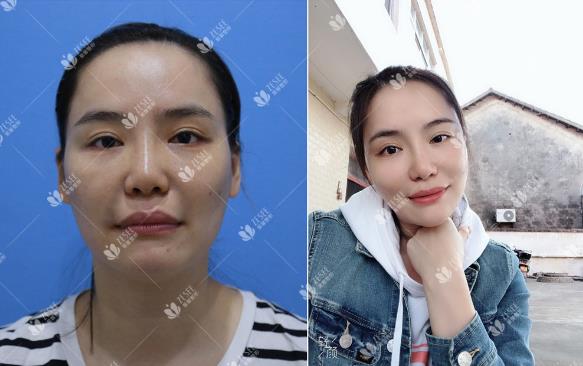 線雕,早做和晚做的區(qū)別原來這么大!