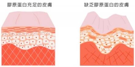 愛爾麗新推出的彈力針讓肌齡變得更自然,再也不僵!