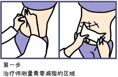 武漢藝星整形醫(yī)院:6月22-28日酷塑減脂專場(chǎng),讓你輕輕松松的減肥!
