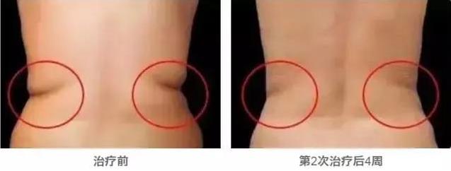 武漢藝星整形醫(yī)院:6月22-28日酷塑減脂專場(chǎng),讓你輕輕松松的減肥!