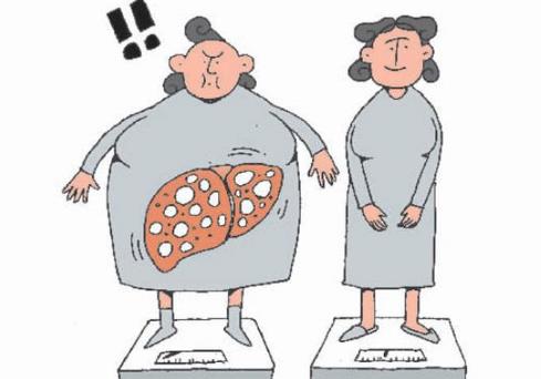脂肪肝的癥狀有哪些?如何預(yù)防脂肪肝