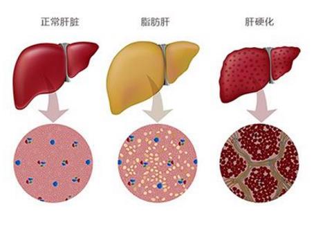 脂肪肝的癥狀有哪些?如何預(yù)防脂肪肝