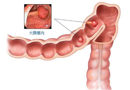 從生活中著手預防大腸癌.jpg