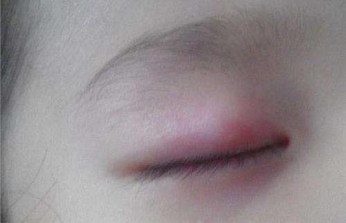 引發(fā)上眼皮腫的原因之長針眼.jpg
