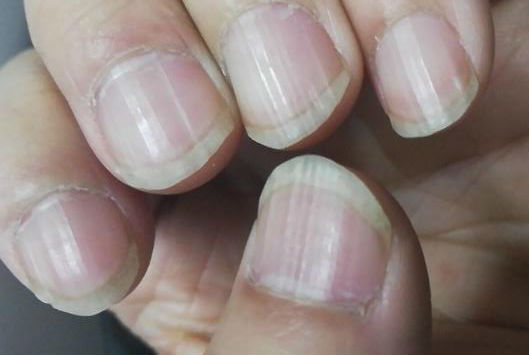 指甲上的月牙是什么?細數(shù)指甲出現(xiàn)的各種癥狀