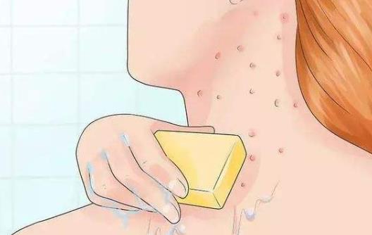 毛囊炎有哪些危害?患毛囊炎有哪些注意事項(xiàng)及護(hù)理?