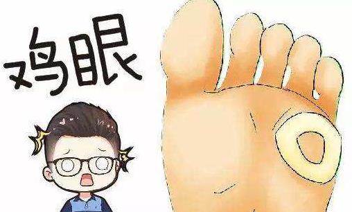 雞眼是什么?雞眼形成的原因有哪些?