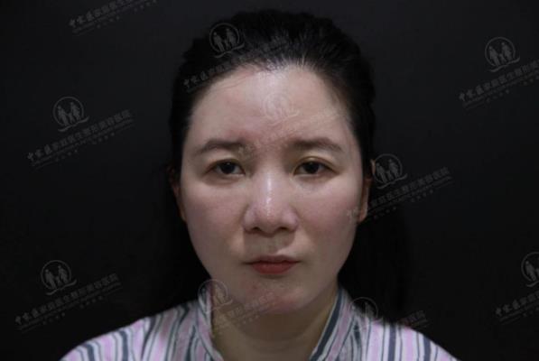 中家醫(yī)整形23周年慶帶你了解做線雕6大優(yōu)勢和效果!