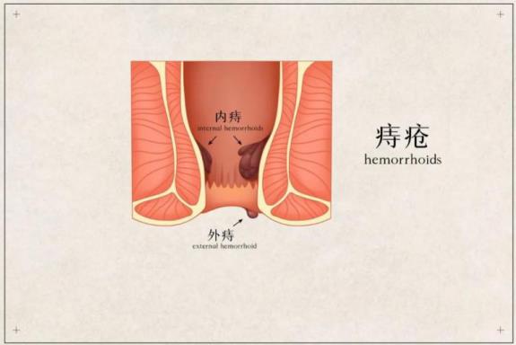 呼市東大肛腸醫(yī)院 一家三口飽受菊花之痛,痔瘡真的會(huì)傳染?