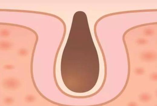 皮膚松弛癥的癥狀有哪些?引起皮膚松弛的原因有哪些?