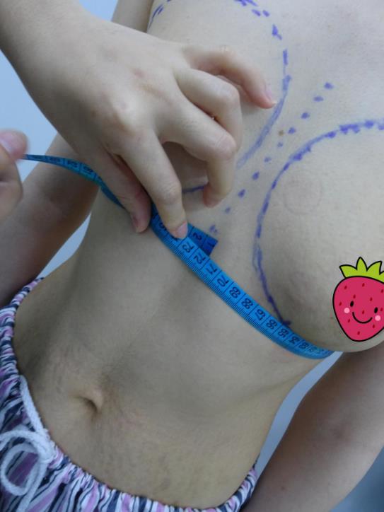 個人豐胸手術(shù)經(jīng)歷 豐胸手術(shù)后手感好不好?包膜攣縮情況等