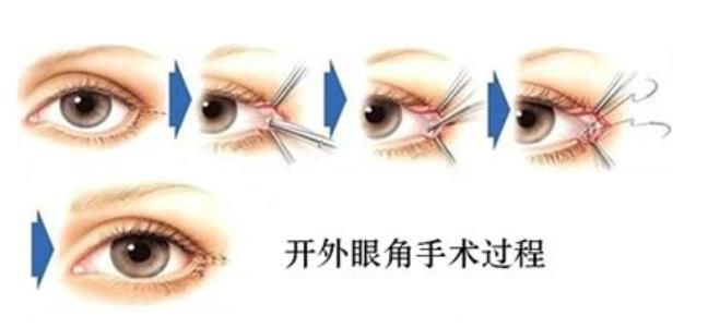 寧波薇琳醫(yī)院靠譜嗎:做乳頭縮小術(shù)去哪好