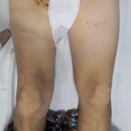 案例 大腿腫脹來勢洶洶,合川宏仁醫(yī)院醫(yī)生及時救治,消失匆匆!