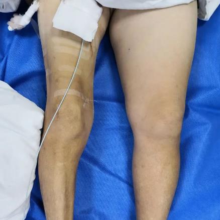 案例 大腿腫脹來勢洶洶,合川宏仁醫(yī)院醫(yī)生及時救治,消失匆匆!