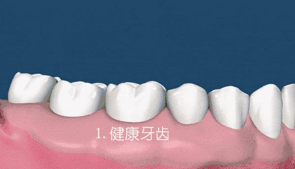 全民愛(ài)牙公益行動(dòng)牙齦炎癥的危害