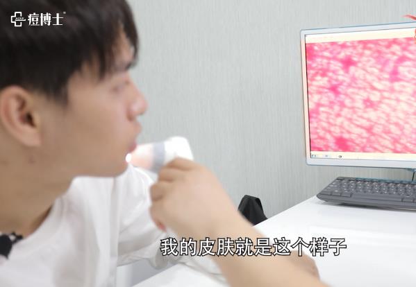 紅人探店||擁有五百萬粉絲的他是如何祛痘的?