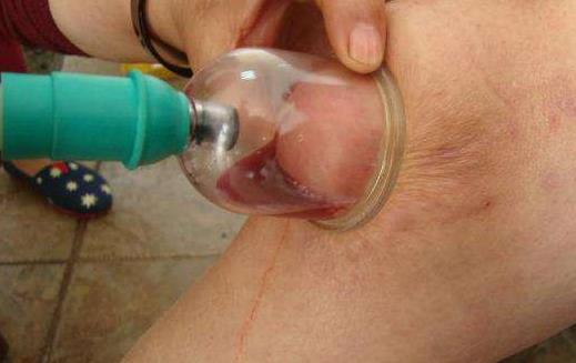 膝蓋積水可以熱敷嗎?怎么預防膝蓋積水?