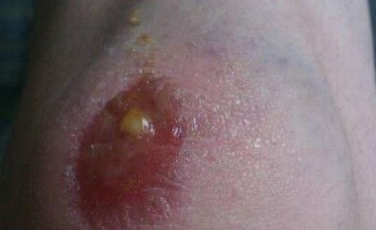傷口為什么會化膿?傷口化膿怎么處理?