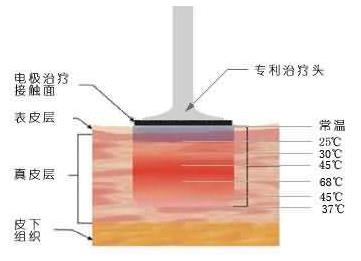 北京石榴美容醫(yī)院:熱瑪吉是不是射頻設(shè)備?